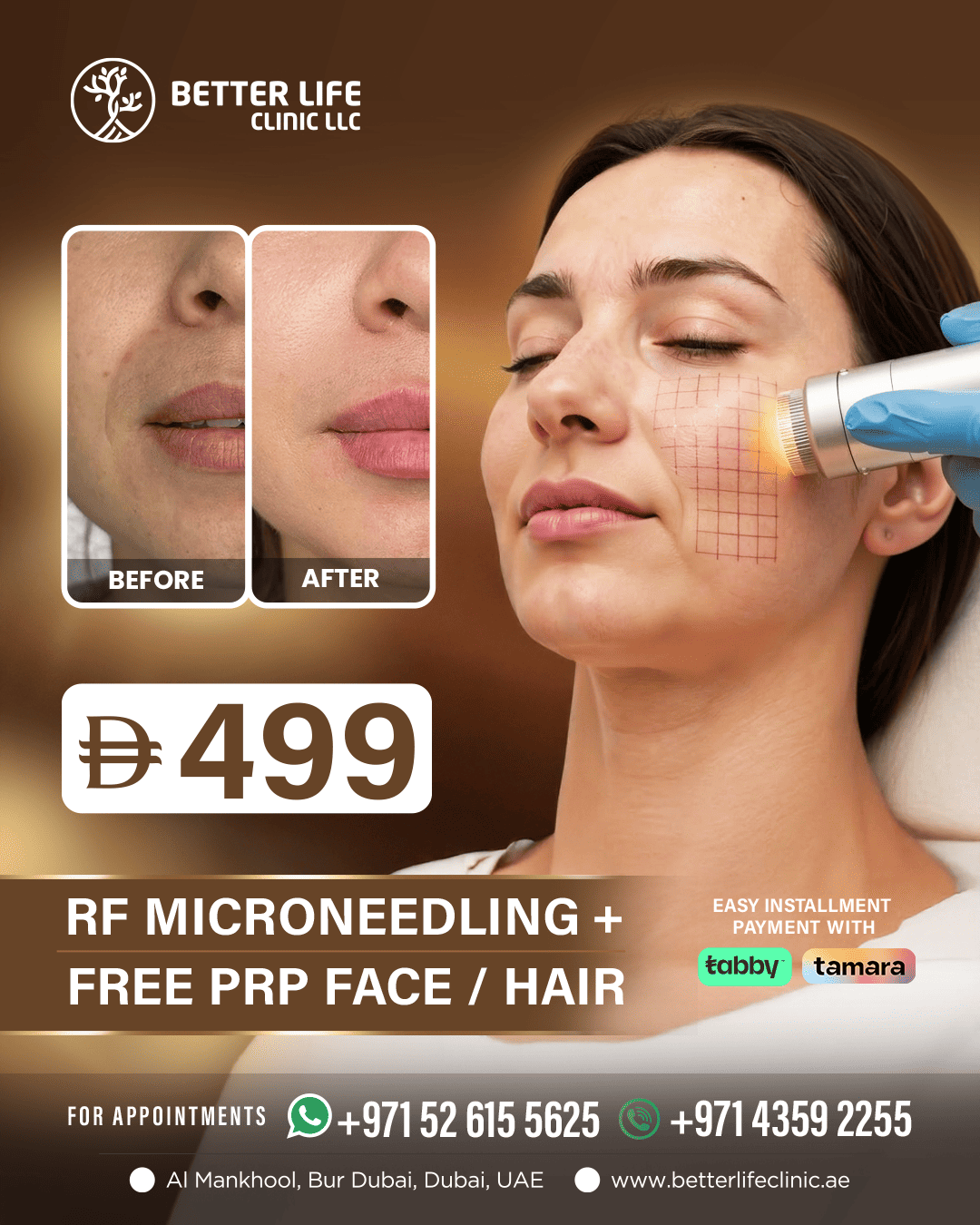 RF Microneedling Treatment – Skin Tightening & Acne Scar Removal