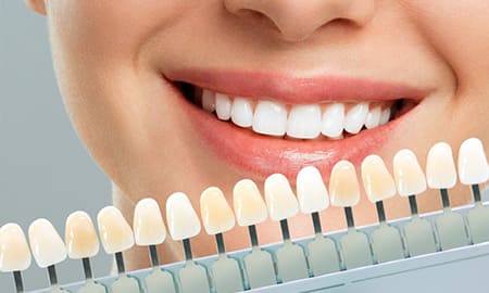Dental Veneers
