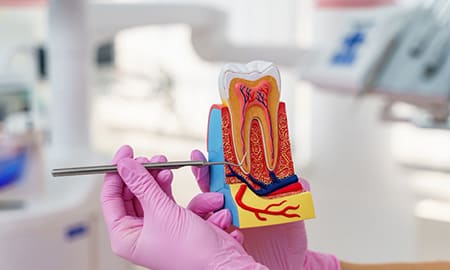 Root Canal Treatment